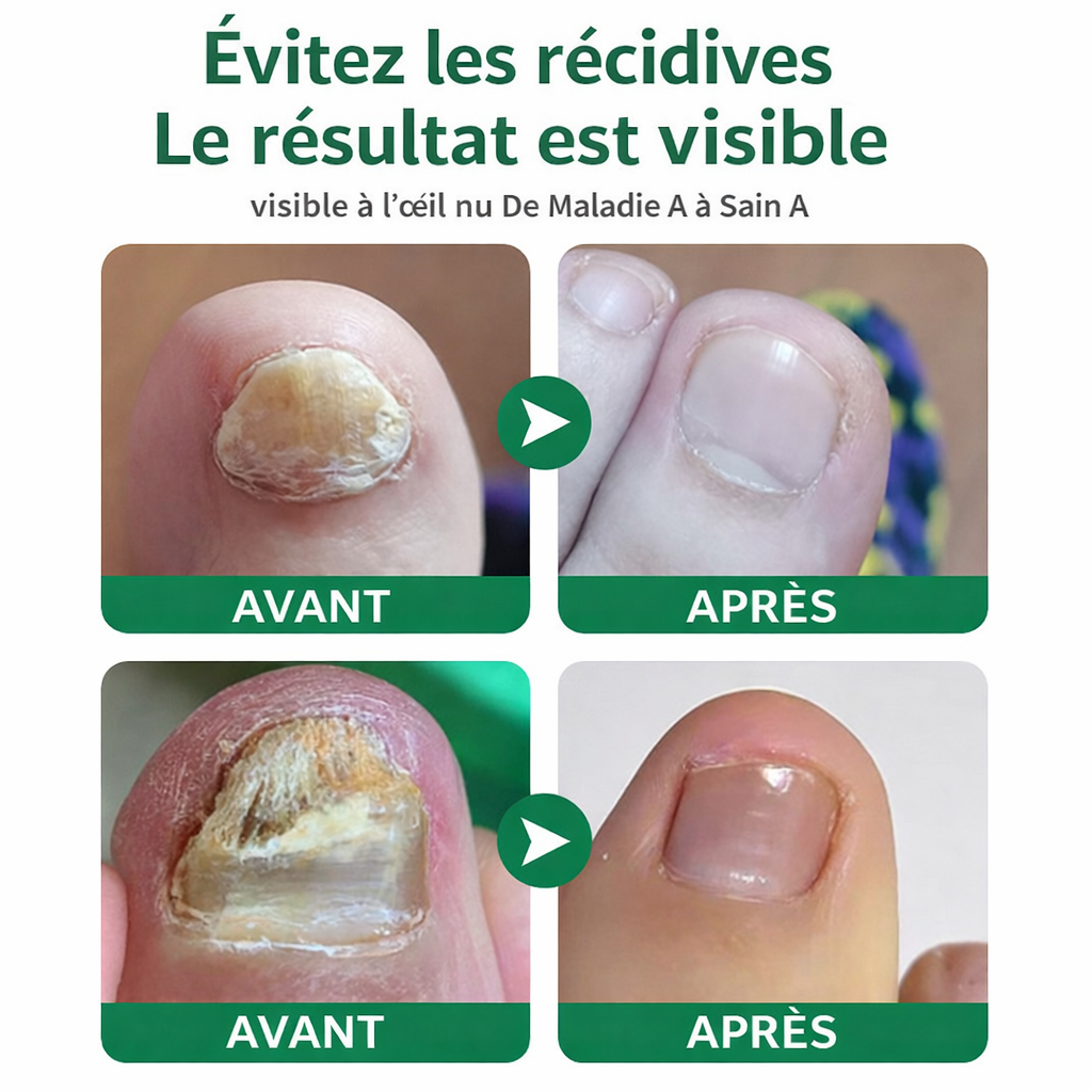 Traitement Mycose des Ongles 7 Jours – Soin Antifongique Réparateur & Fortifiant 30ml